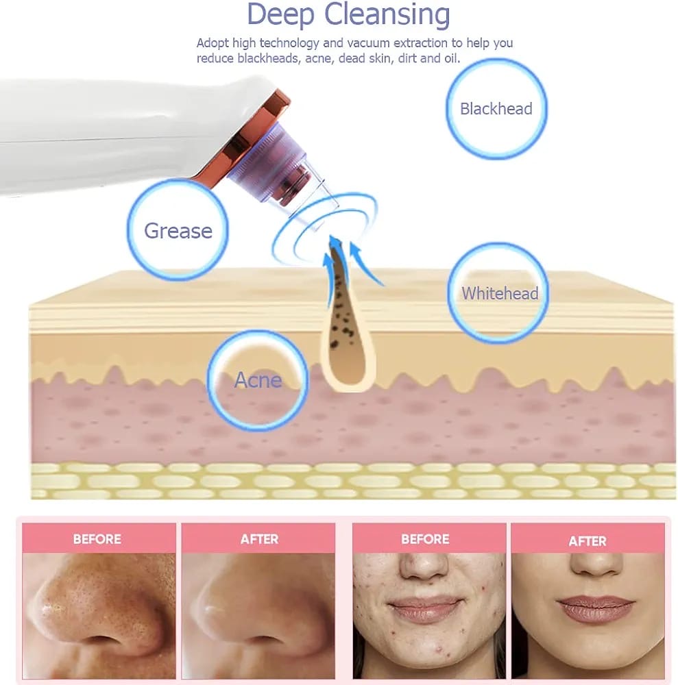 Daweir Upgraded Blackhead Remover Pore Vacuum Cleaner – Deep Cleansing Facial Kit for Blackhead & Blemish Removal
