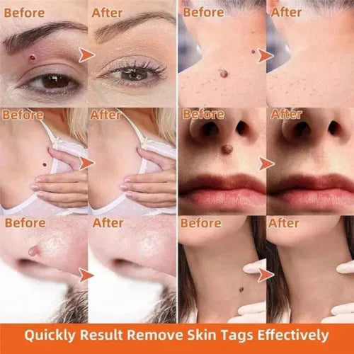 Warts Remover Original Cream