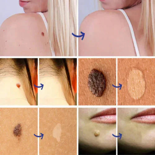 Warts Remover Original Cream