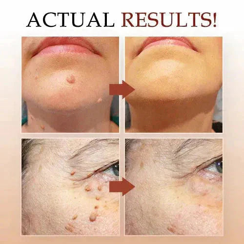 Warts Remover Original Cream